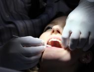 Erosione dentale cause e prevenzione